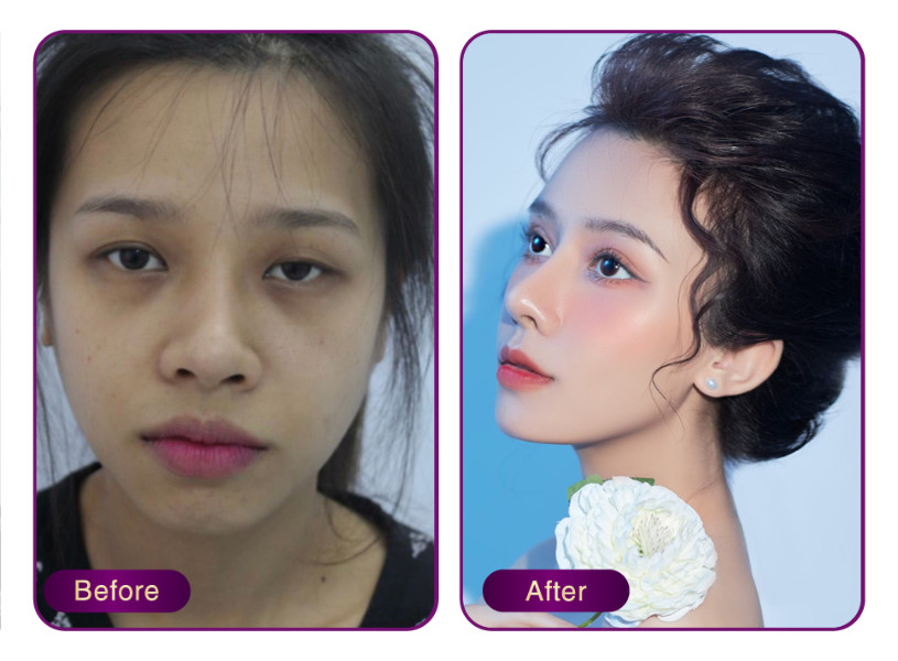 Hình ảnh khách hàng Phương Vy trước và sau khi nâng mũi sụn sườn Babie Line Dsoft 5.0